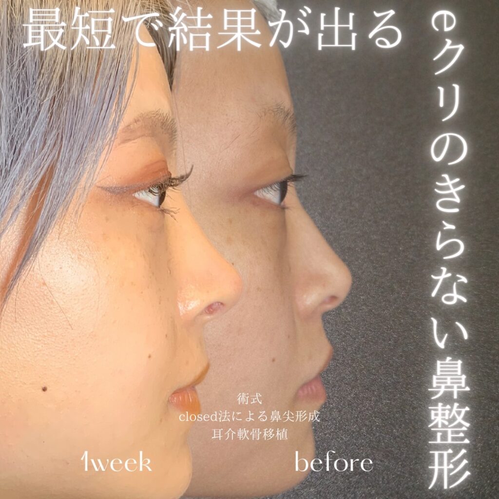 名古屋院の鼻尖形成と軟骨移植の症例