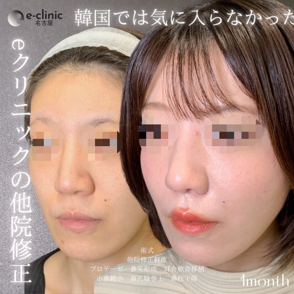 名古屋院の鼻整形の他院修正の症例