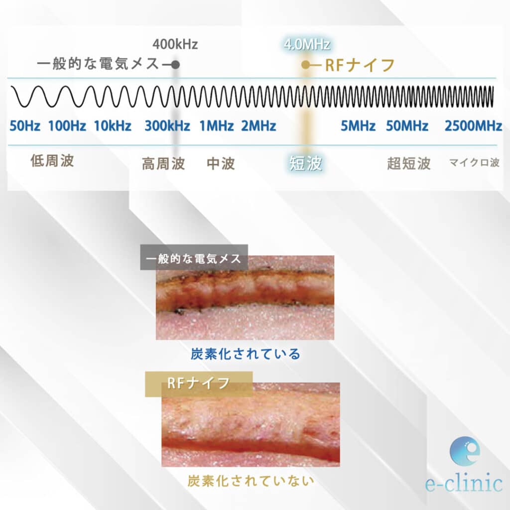 RFナイフの図解