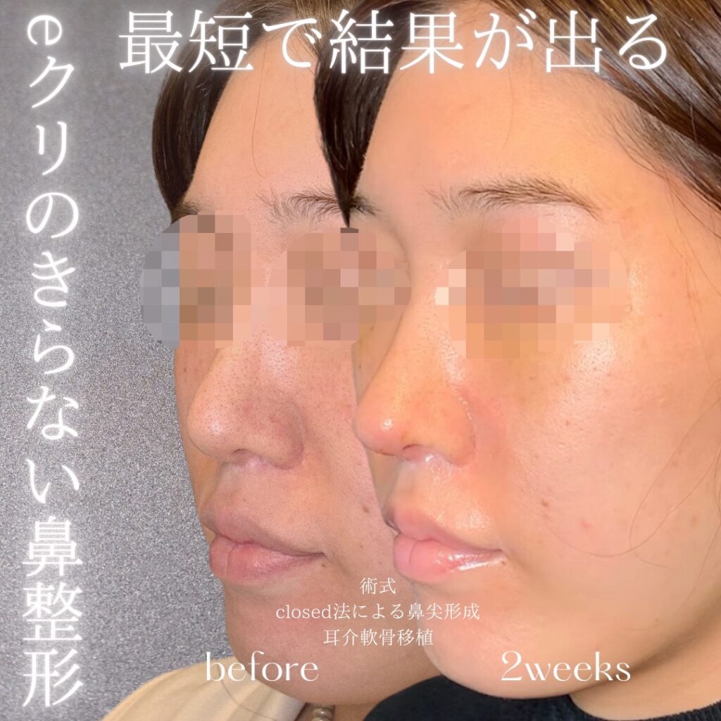 名古屋院のクローズ法の鼻尖形成と耳介軟骨移植の症例