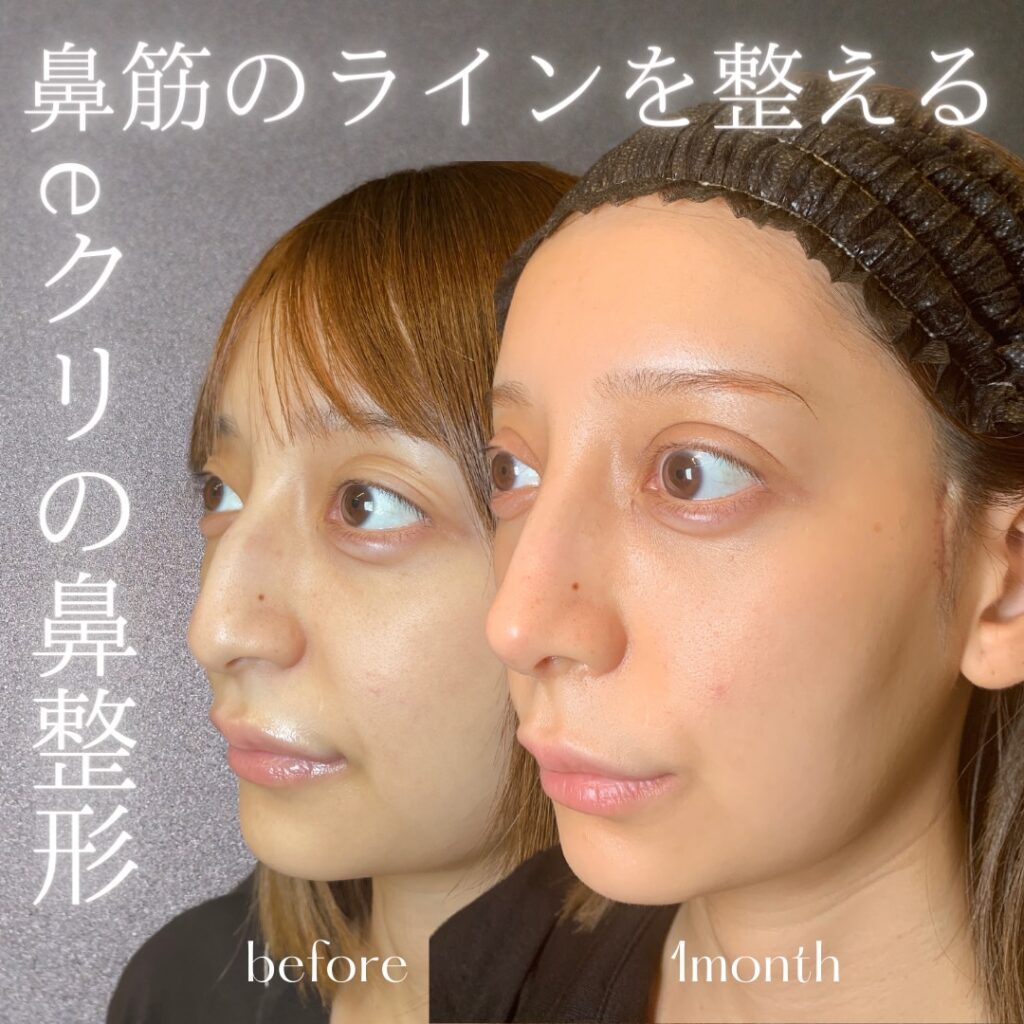 名古屋院の鼻整形の症例