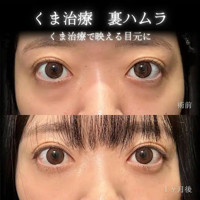 裏ハムラ