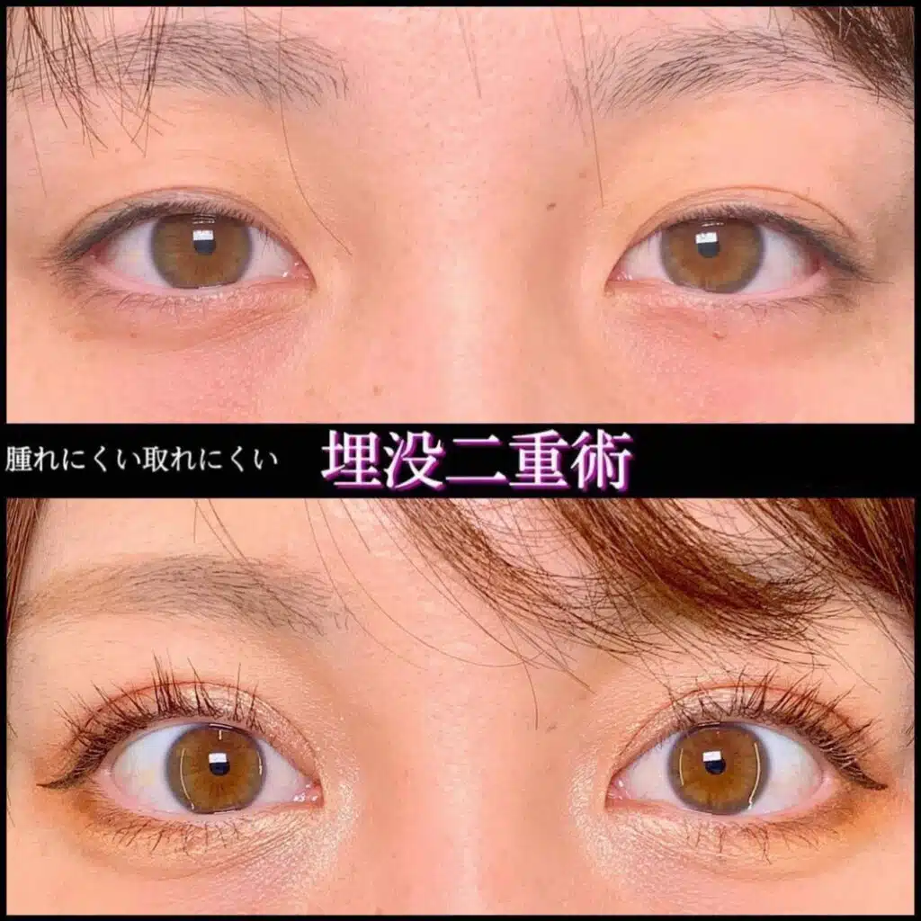 埋没法