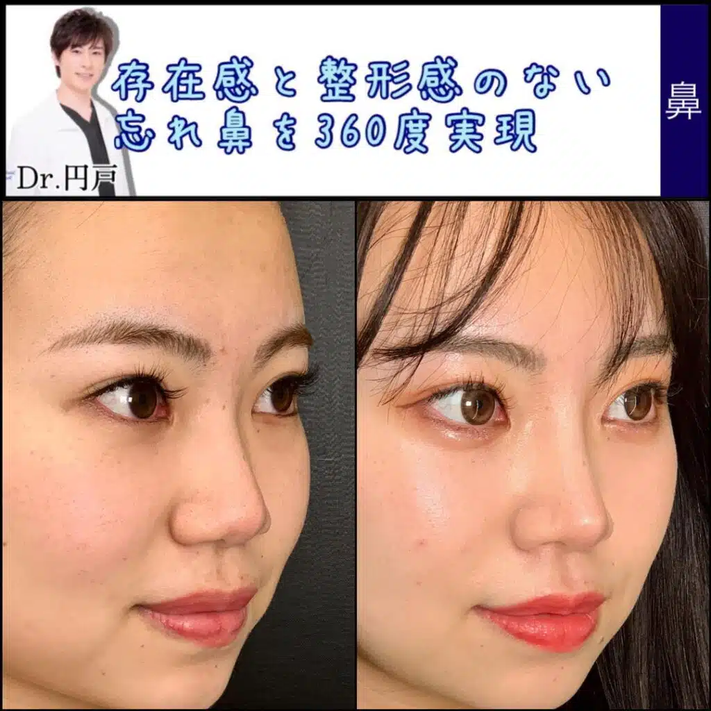 鼻尖形成