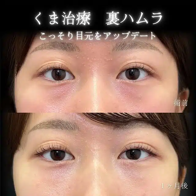 裏ハムラ法