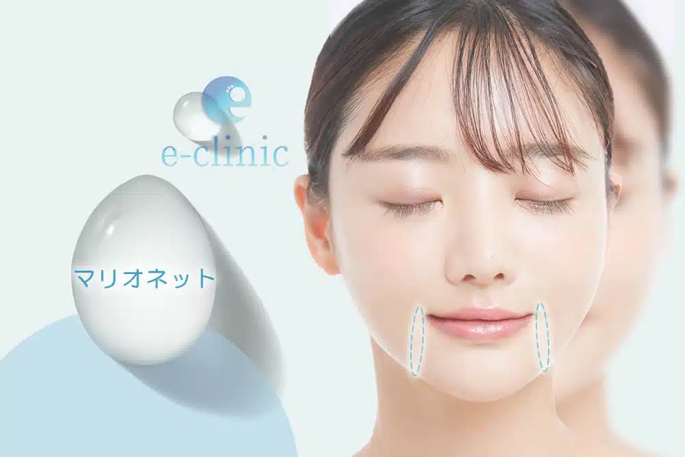ヒアルロン酸　マリオネットライン