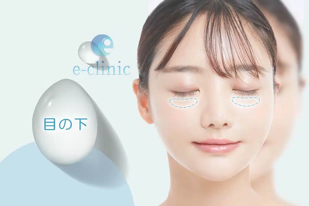 ヒアルロン酸　目の下