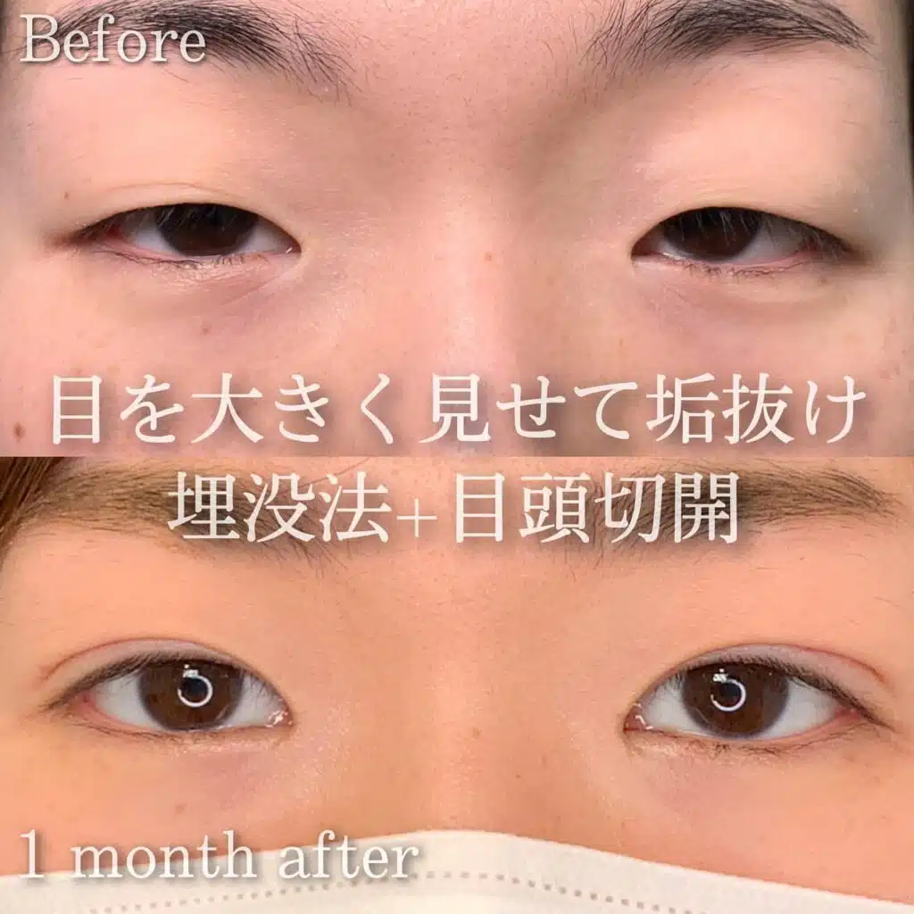 埋没 目頭切開