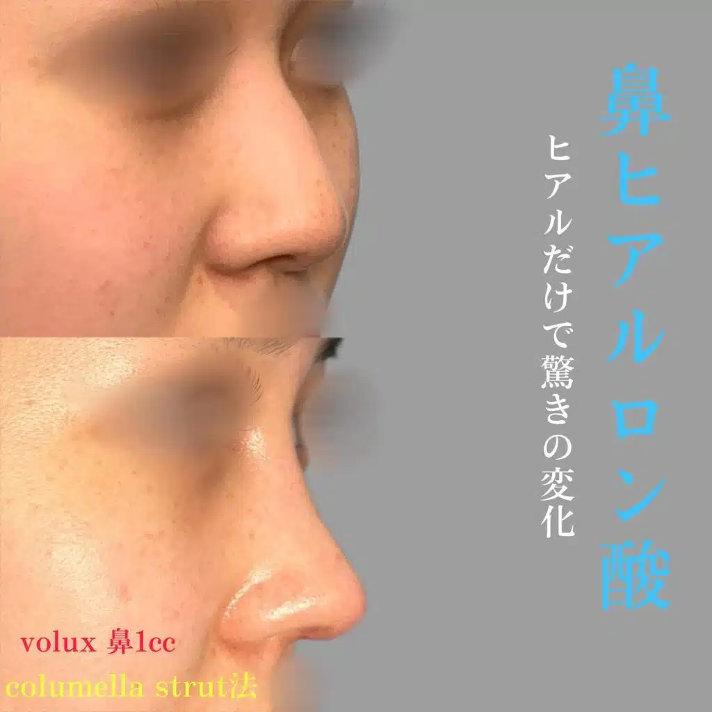 ヒアルロン酸　鼻