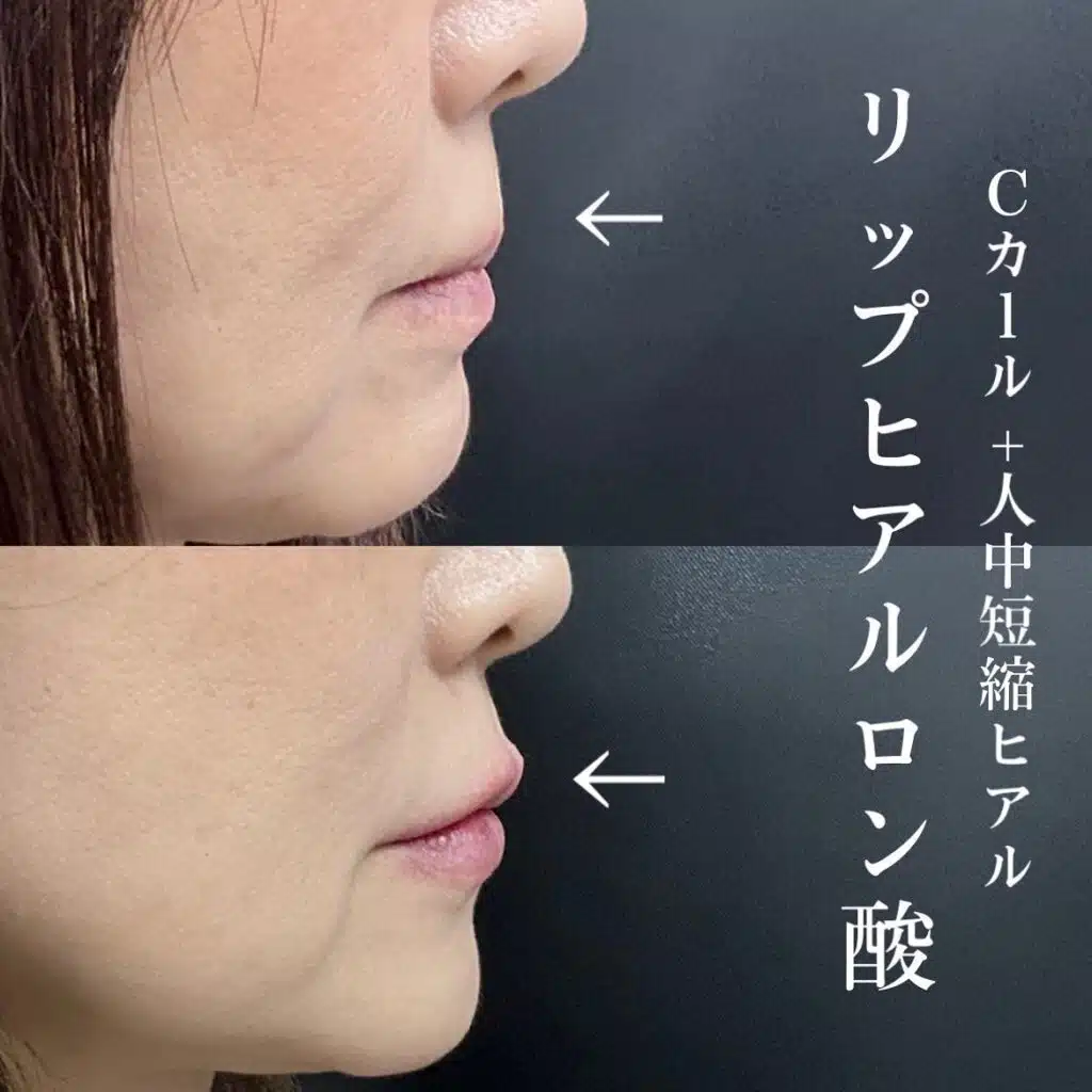 ヒアルロン酸　唇