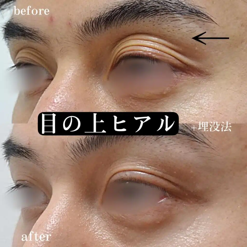 ヒアルロン酸　目の上