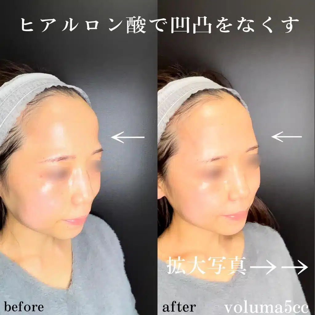 ヒアルロン酸　こめかみ