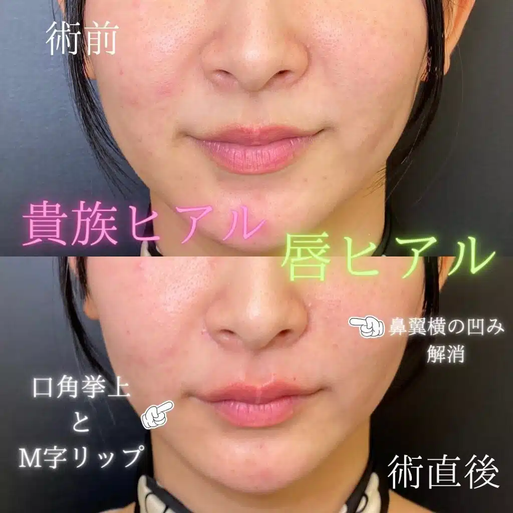 ヒアルロン酸　唇