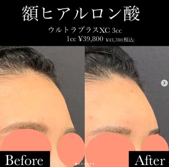 ヒアルロン酸　額