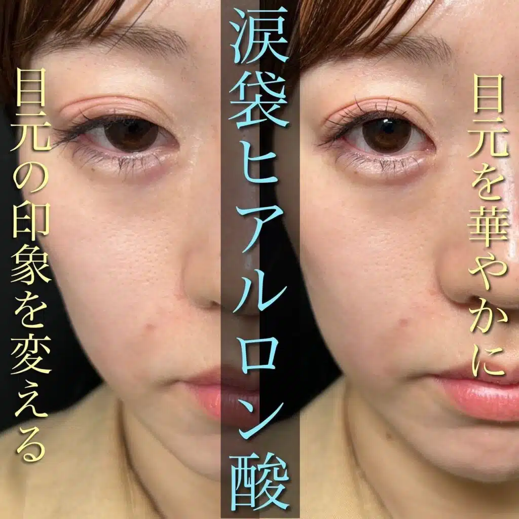 ヒアルロン酸　涙袋