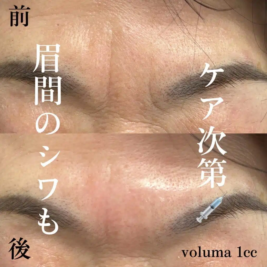 ヒアルロン酸　眉間