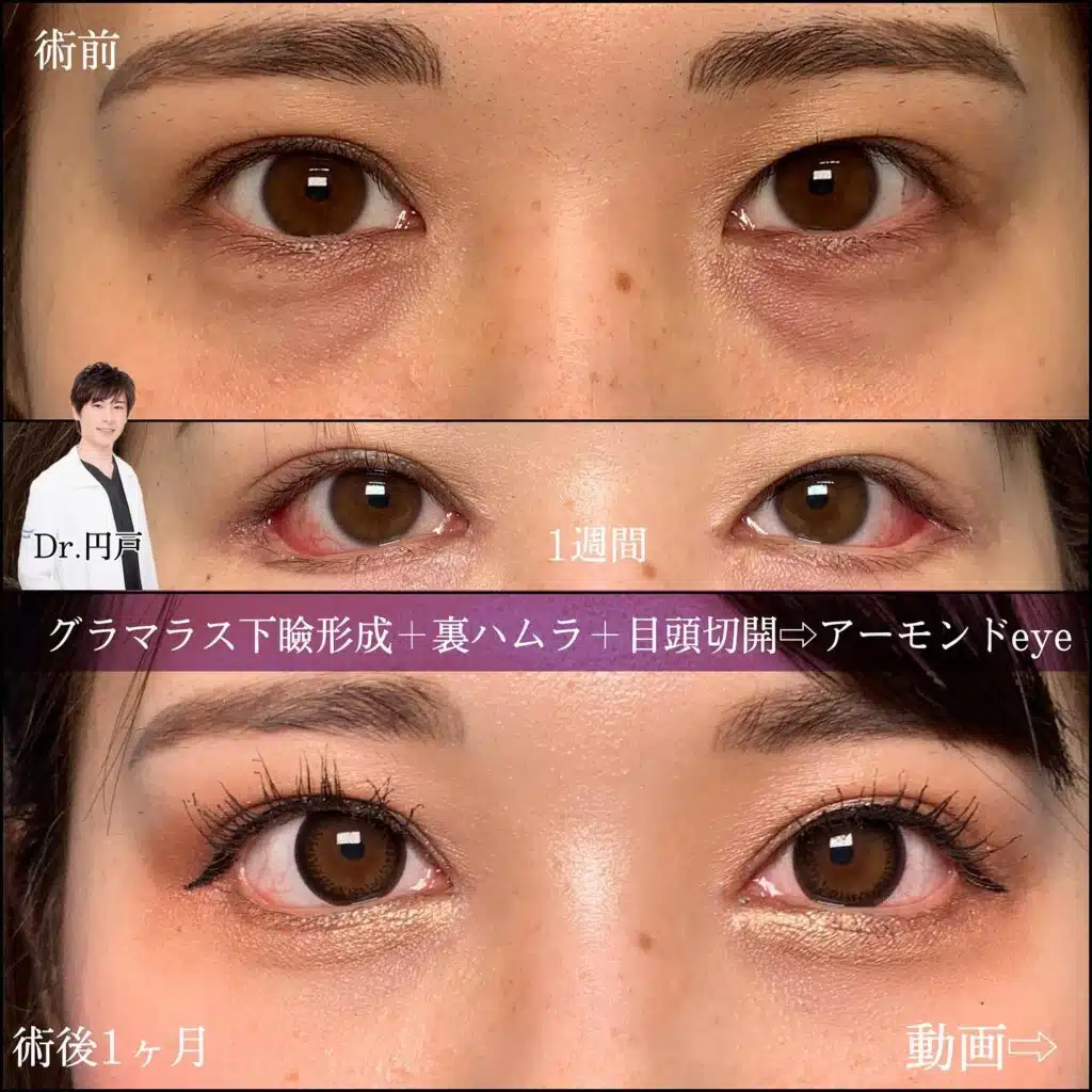 グラマラス下瞼形成、裏ハムラ