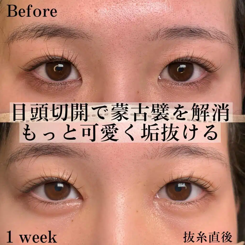 目頭切開
