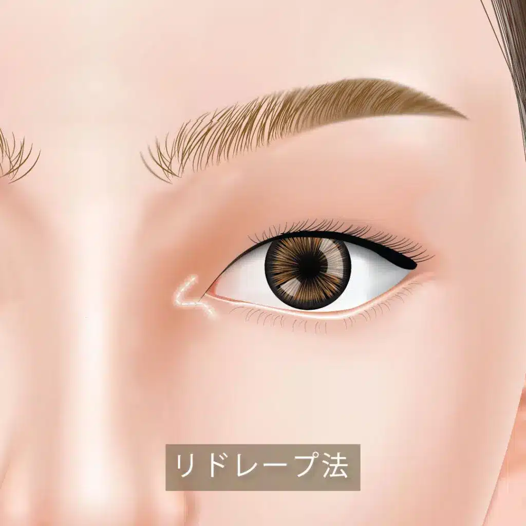 リドレープ法