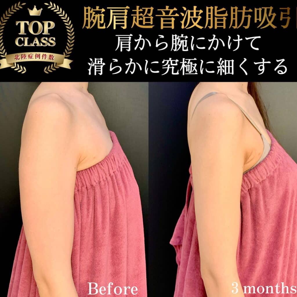 eclinic名古屋院の腕脂肪吸引の症例写真
