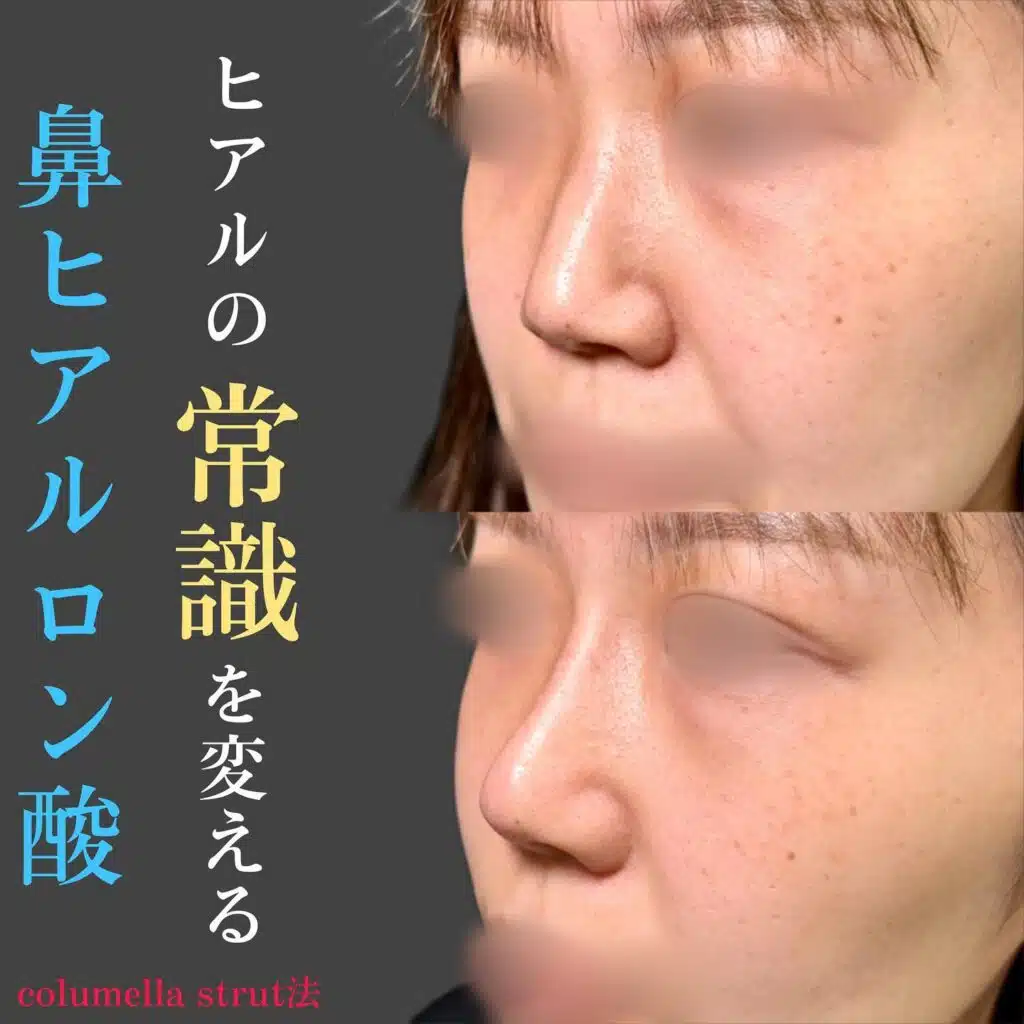 ヒアルロン酸　鼻