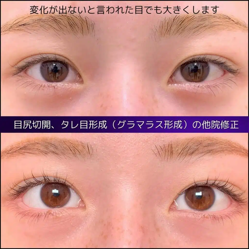 グラマラスライン形成