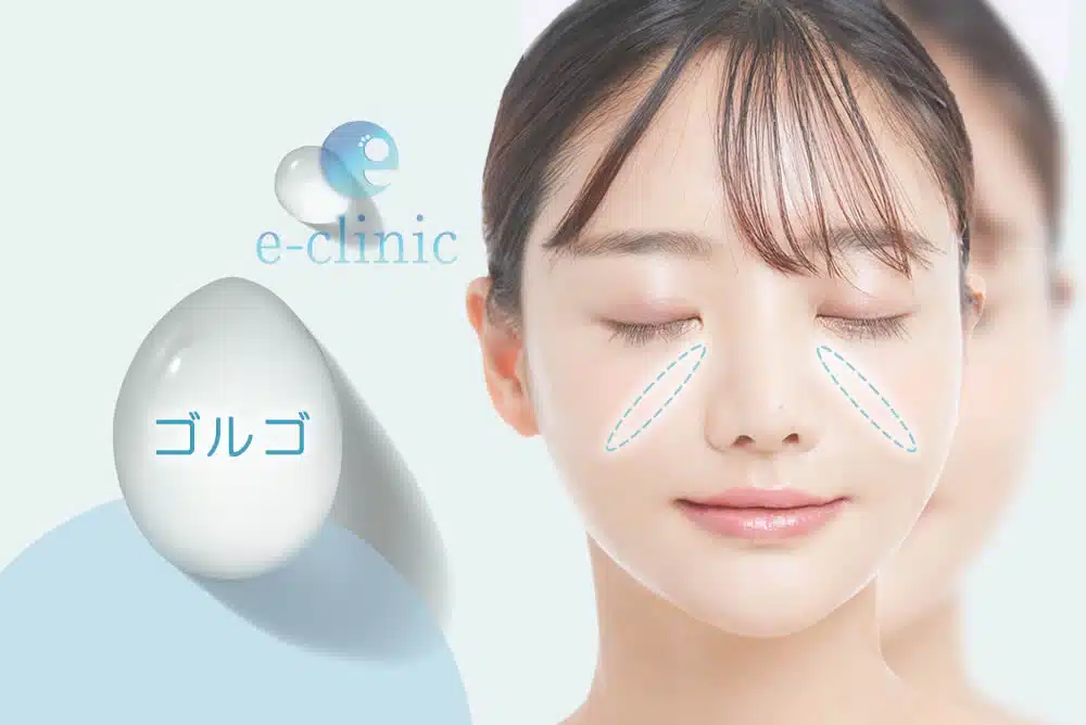 ヒアルロン酸　ゴルゴライン