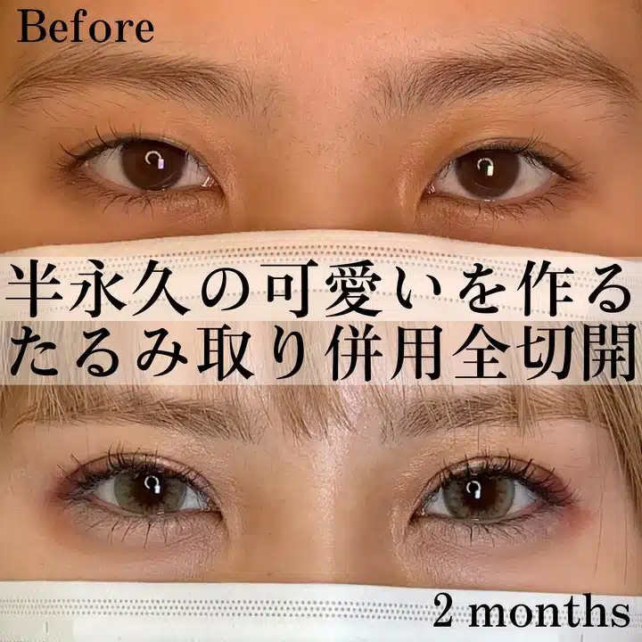 二重全切開
