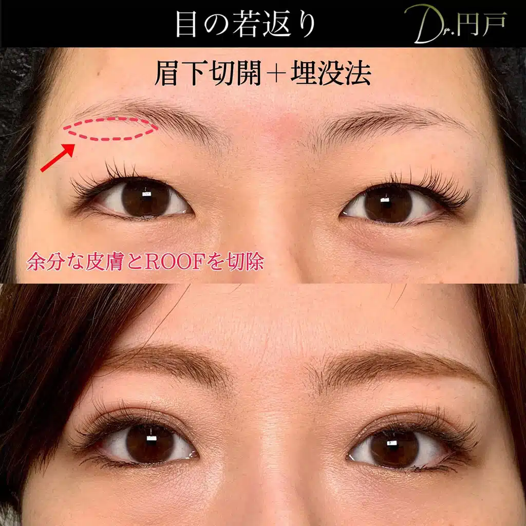 眉下切開　埋没法