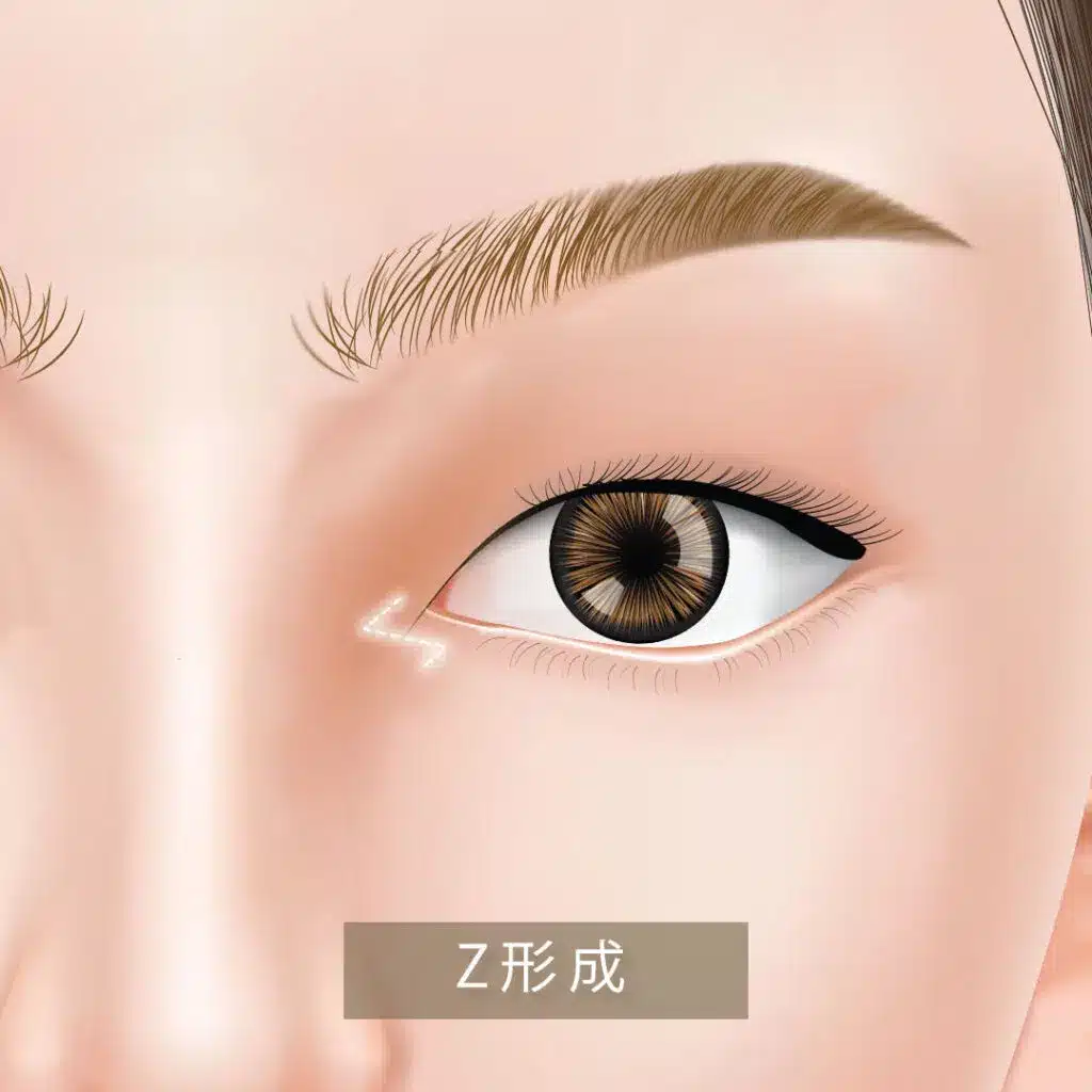 Z法