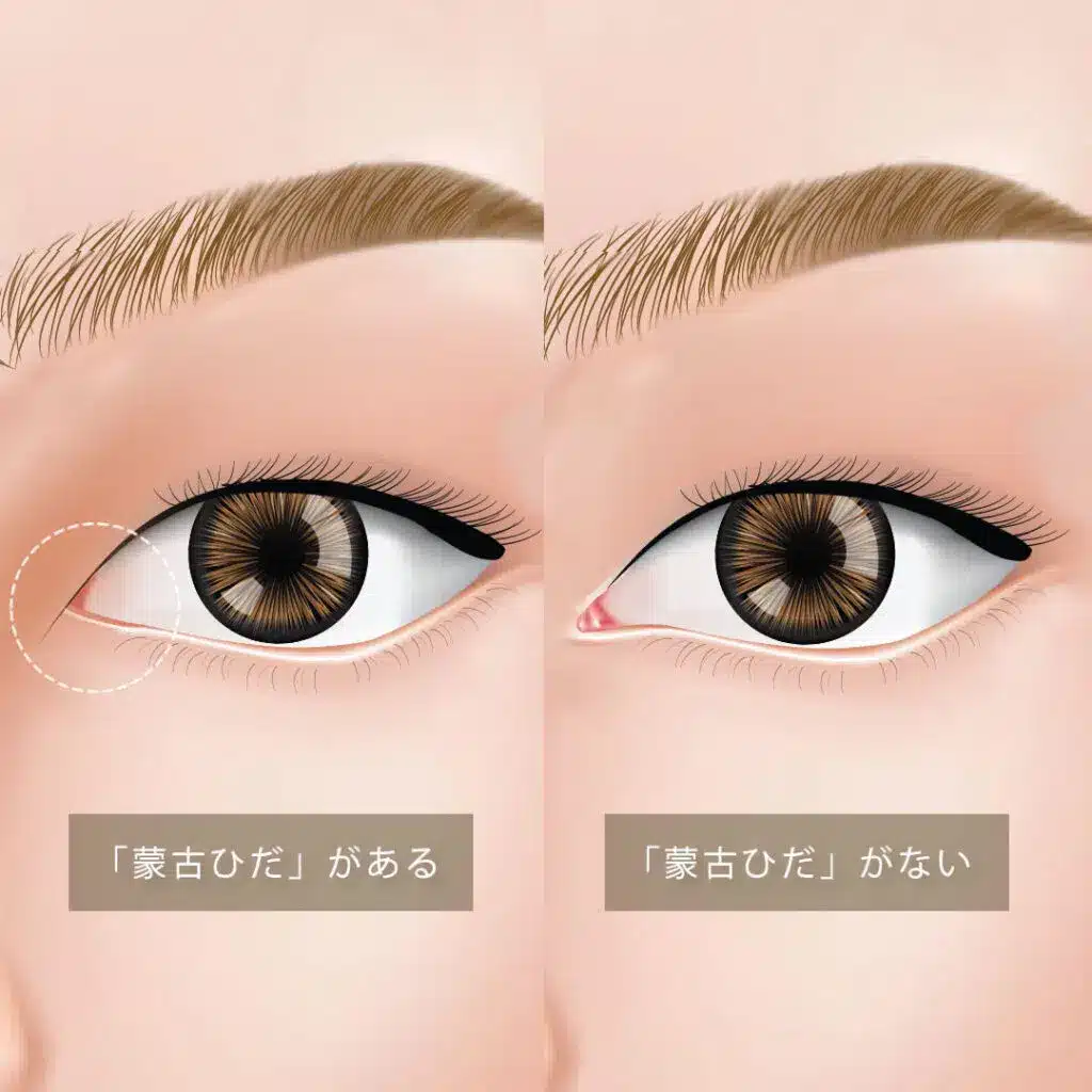 目頭切開