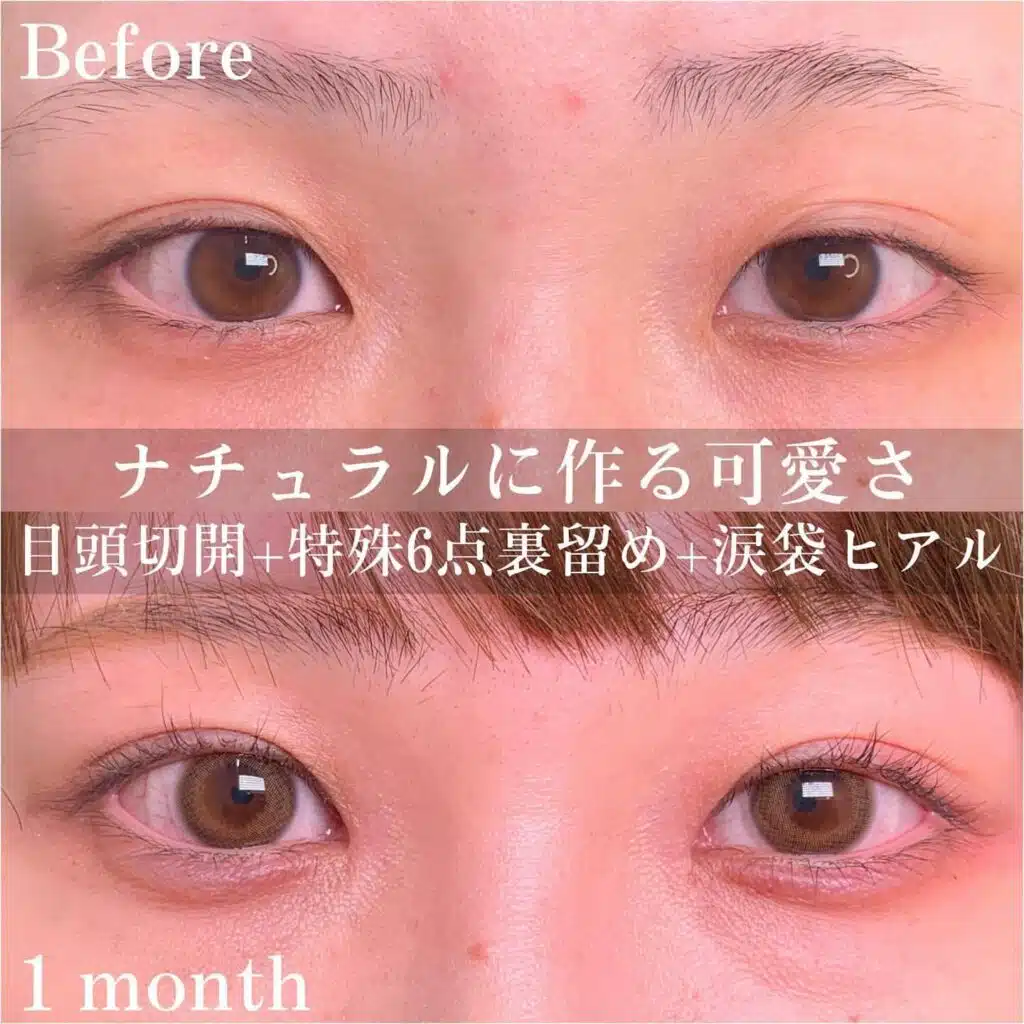 目頭切開　