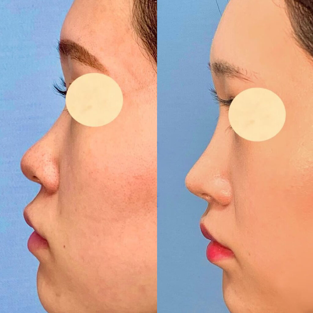 人中短縮と鼻唇角形成と鼻尖形成と軟骨移植の症例写真