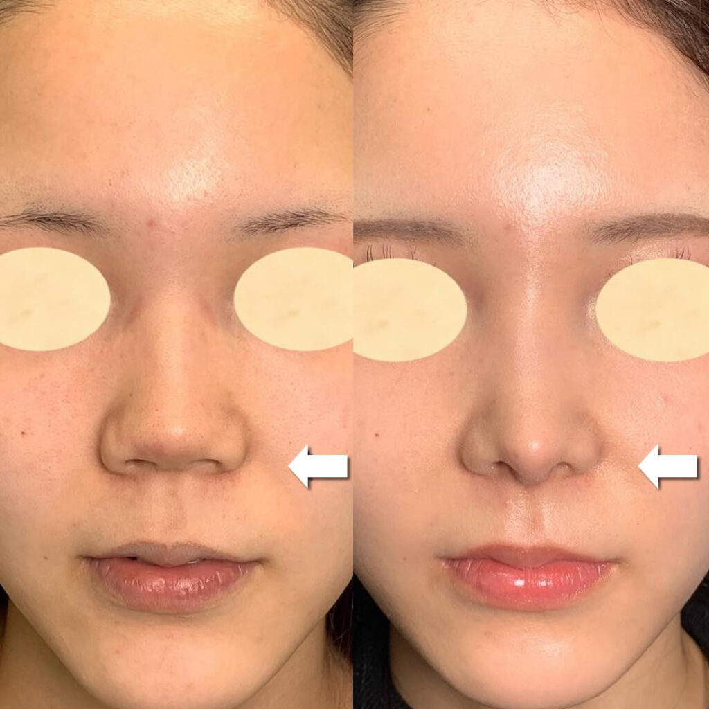 鼻中隔延長の２０代の女性の症例写真