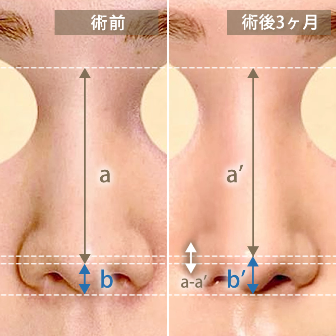 鼻中隔延長で各パーツの比率を調整している図解