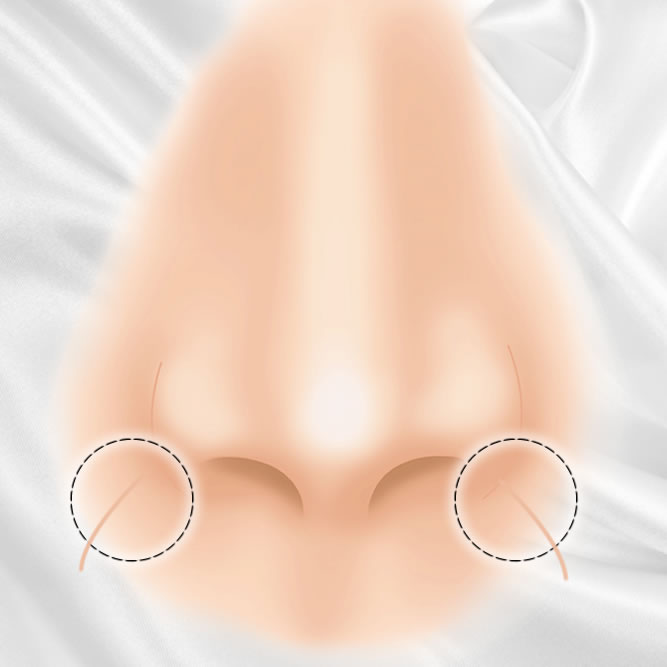 鼻の横の陥没の整形のアイコン