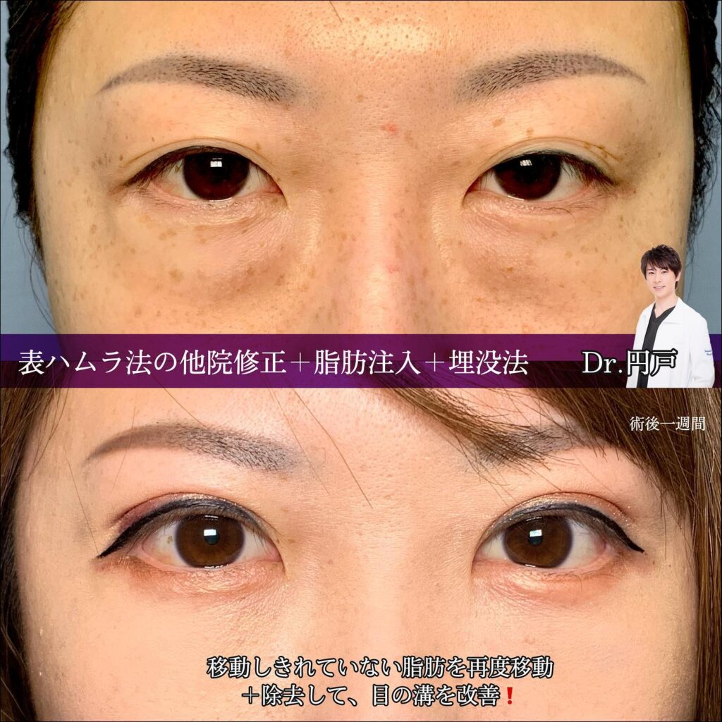 表ハムラの他院修正の症例