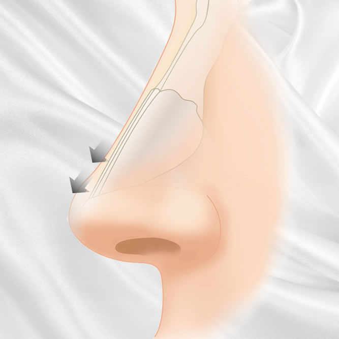 鼻中隔延長術のアイコン