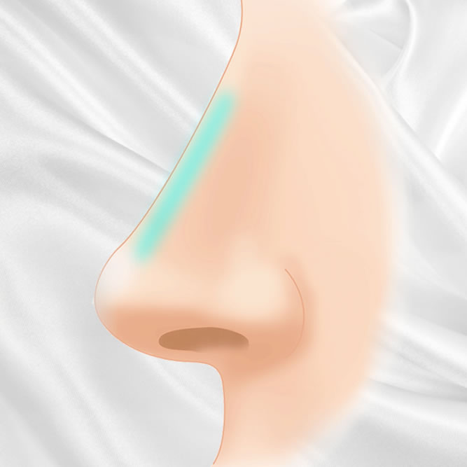 鼻のヒアルロン酸のアイコン
