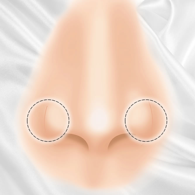 小鼻の整形のアイコン