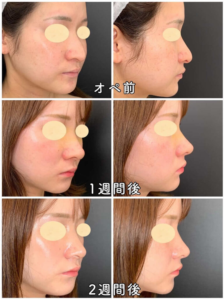 鼻骨骨切りの１週間後と２週間後の経過の症例写真