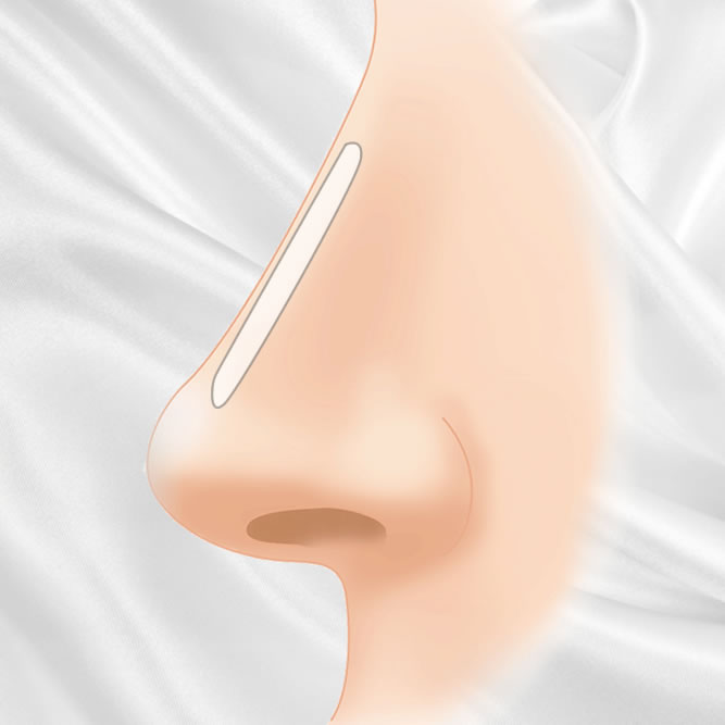 鼻のプロテーゼのアイコン