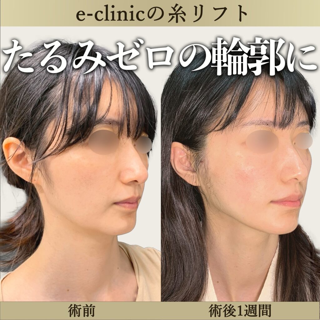 糸リフト