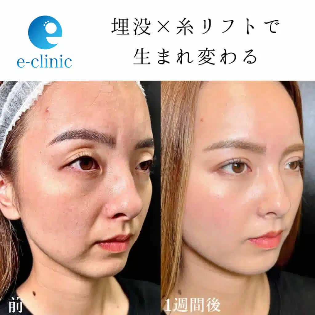糸リフト