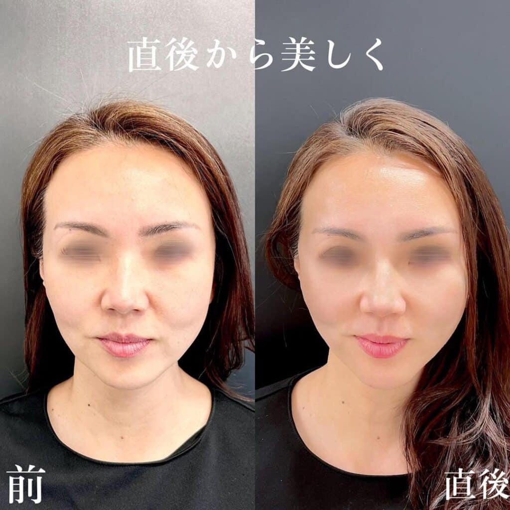 糸リフト
