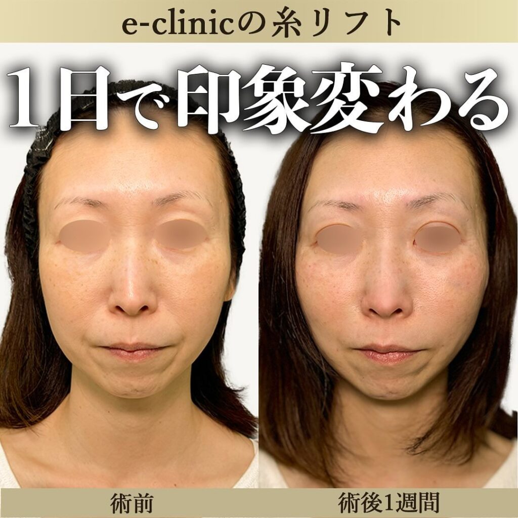 糸リフト