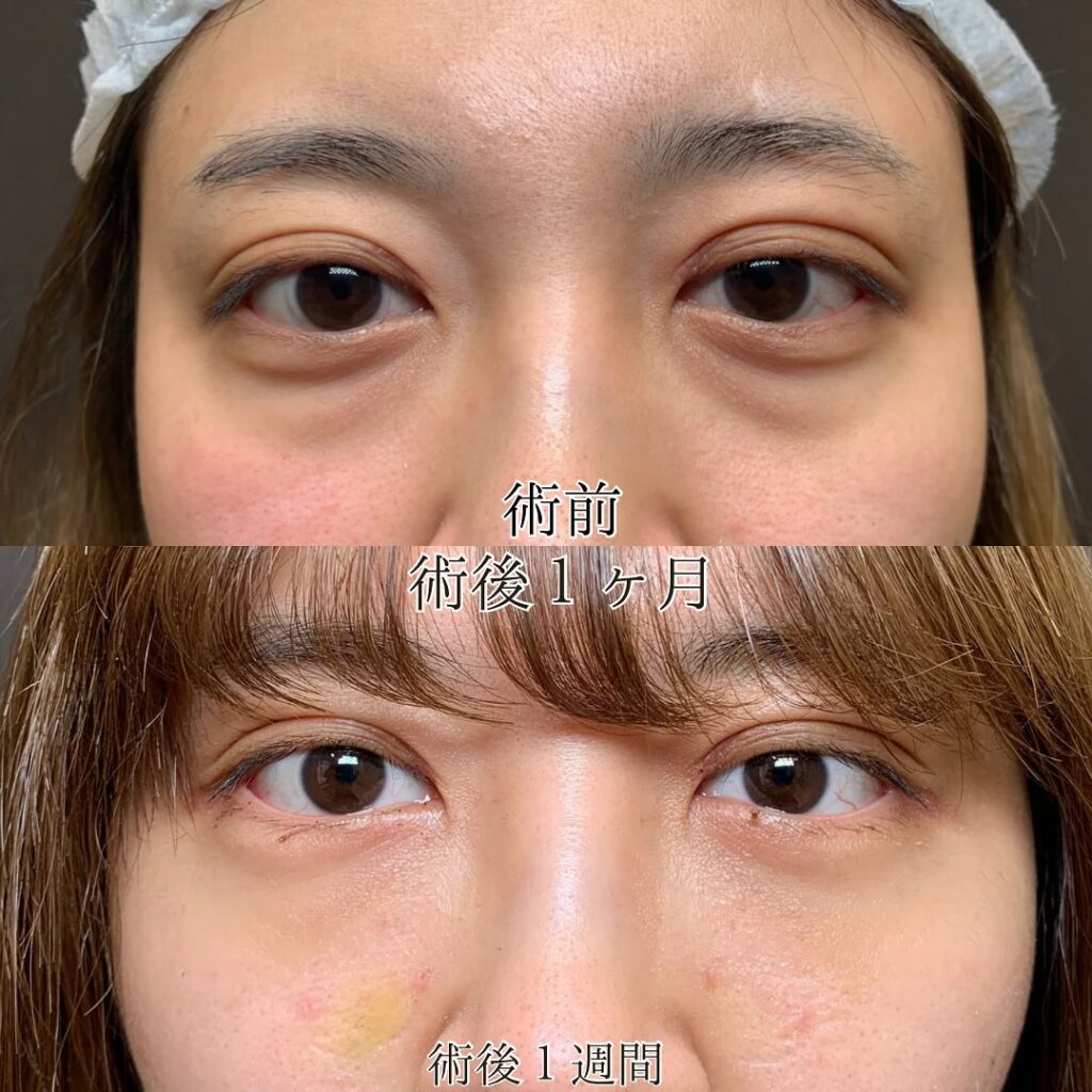 名古屋院の裏ハムラの術後1週間のダウンタイムの症例写真