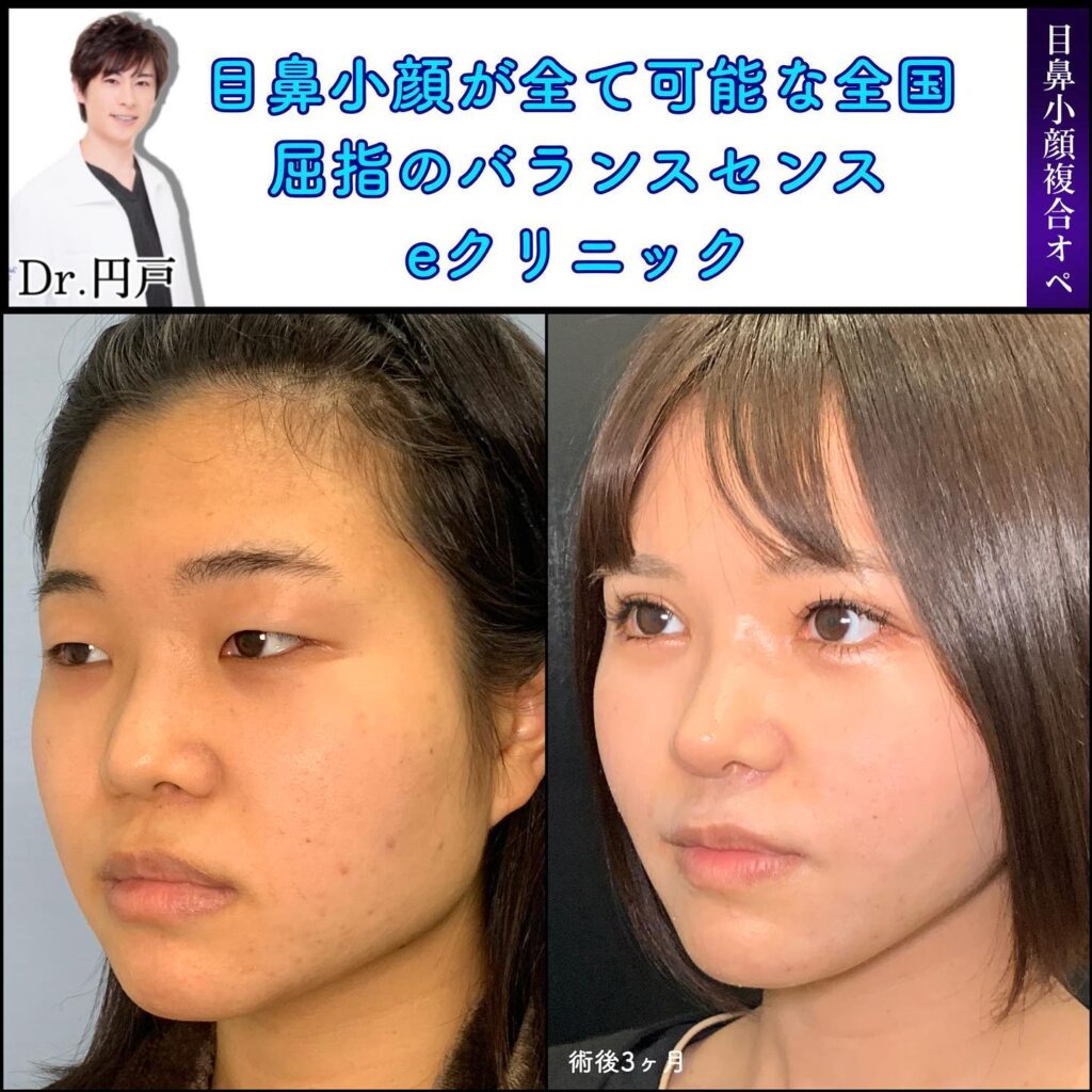 目のフル整形（目頭切開、タレ目形成、目尻靱帯移動、眼瞼下垂、全切開）と鼻のフル整形（小鼻縮小、鼻尖形成、軟骨移植、鼻中隔延長、オステオポール除去）と顔の脂肪吸引と糸リフトを併用した斜めから見た症例写真