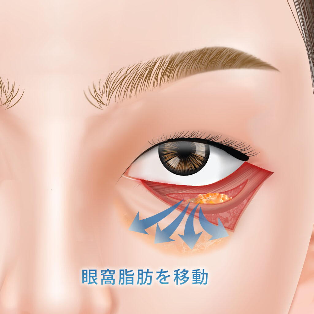 表ハムラの眼窩脂肪の移動の図解