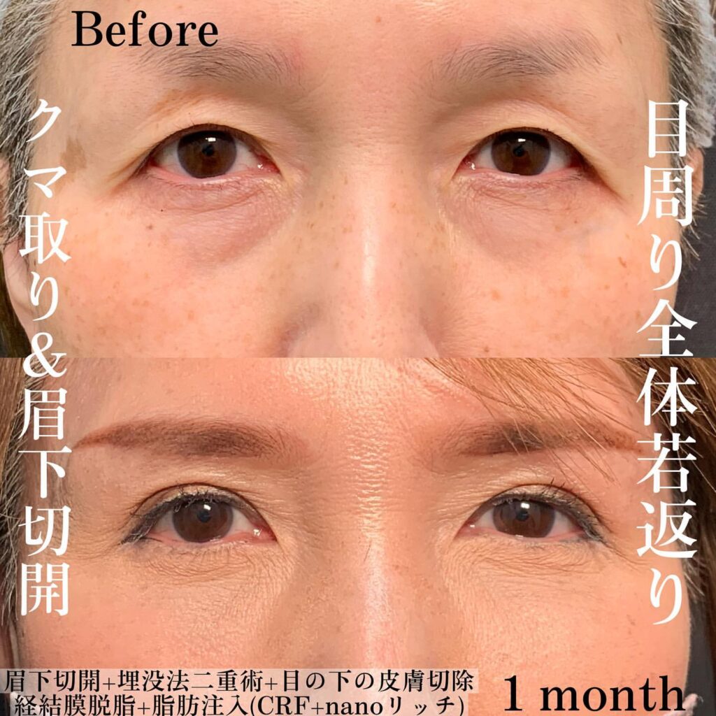 eクリニック名古屋院の経結膜脱脂と脂肪注入と埋没法と眉下切開の症例写真（4）